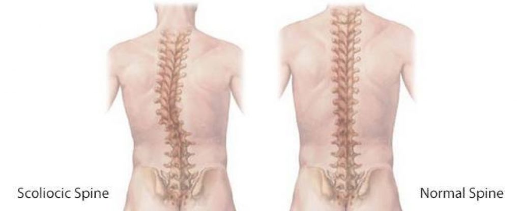 Scoliocic Spine Vs Normal